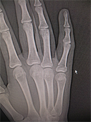 レントゲン写真