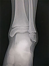 レントゲン写真